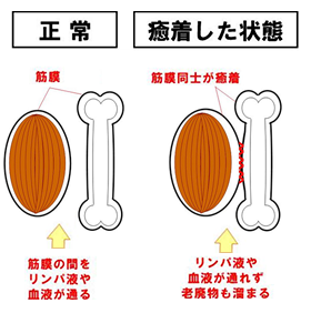 筋膜リリース